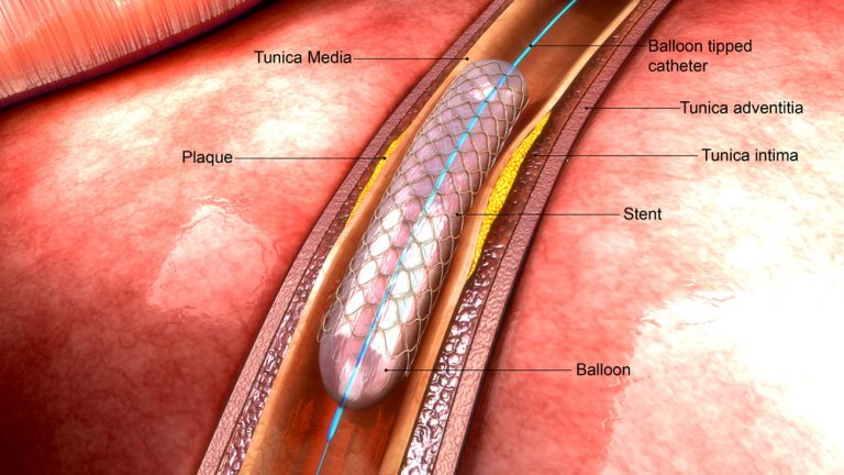 angioplasty-drug-and-device-watch